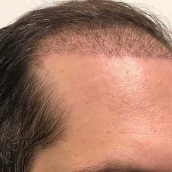 Hair Restoration Before & After Patient #2754