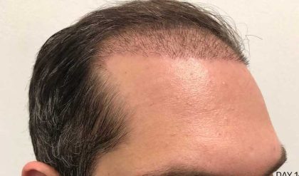 Hair Restoration Before & After Patient #2754
