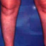 Liposuction Before & After Patient #2832