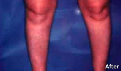 Liposuction Before & After Patient #2832