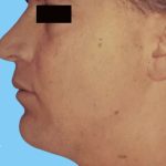 Liposuction Male Before & After Patient #2891