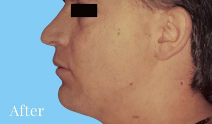 Liposuction Male Before & After Patient #2891