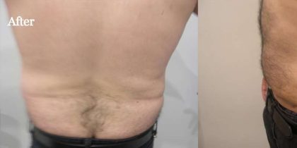 Daddy Makeover Before & After Patient #2503