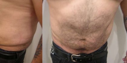 Daddy Makeover Before & After Patient #2503