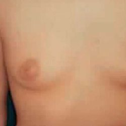 Breast Augmentation Before & After Patient #2210