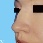 Rhinoplasty Before & After Patient #2964
