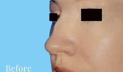 Rhinoplasty Before & After Patient #2964