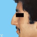 Rhinoplasty Male Before & After Patient #3018