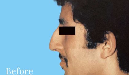 Rhinoplasty Male Before & After Patient #3018