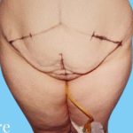 Tummy Tuck Before & After Patient #3051
