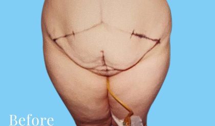 Tummy Tuck Before & After Patient #3051