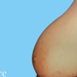 Breast Reduction Before & After Patient #2320