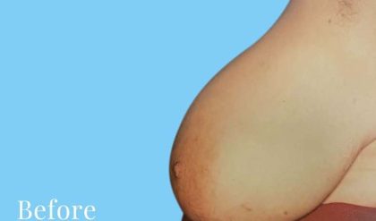 Breast Reduction Before & After Patient #2320
