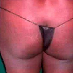 Buttock Augmentation Before & After Patient #2399