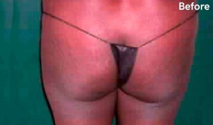 Buttock Augmentation Before & After Patient #2399