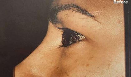 Eyelid Surgery Before & After Patient #2605