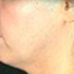 Facelift Before & After Patient #2641