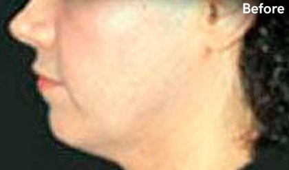 Facelift Before & After Patient #2641