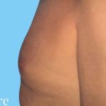 Gynecomastia Before & After Patient #2704