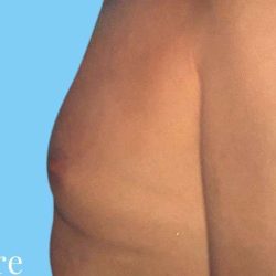 Gynecomastia Before & After Patient #2704