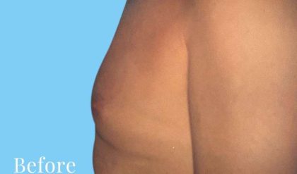 Gynecomastia Before & After Patient #2704