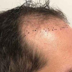 Hair Restoration Before & After Patient #2754