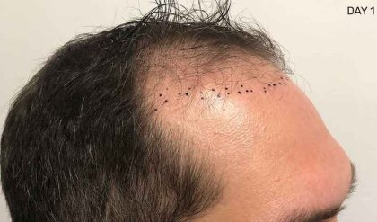 Hair Restoration Before & After Patient #2754