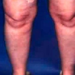 Liposuction Before & After Patient #2832