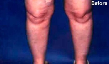 Liposuction Before & After Patient #2832