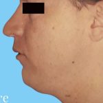 Liposuction Male Before & After Patient #2891