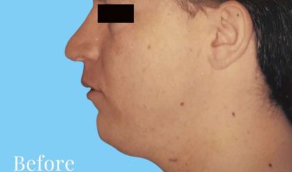 Liposuction Male Before & After Patient #2891