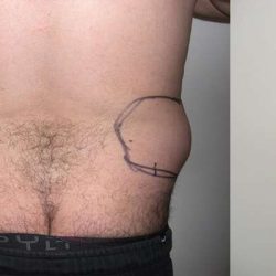 Daddy Makeover Before & After Patient #2503