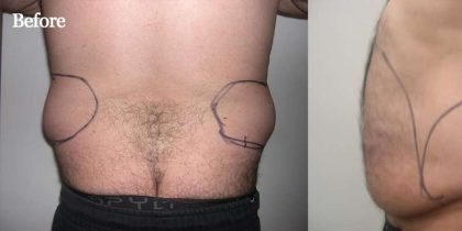 Daddy Makeover Before & After Patient #2503