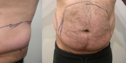 Daddy Makeover Before & After Patient #2503