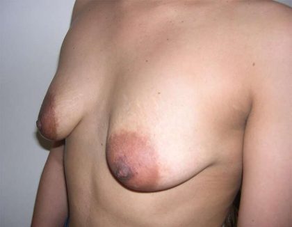 Breast Lift Before & After Patient #2288