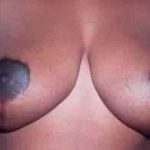 Breast Reduction Before & After Patient #2332