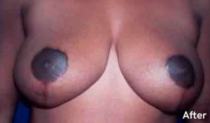 Breast Reduction Before & After Patient #2332