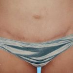 Tummy Tuck Before & After Patient #3063