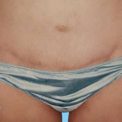 Tummy Tuck Before & After Patient #3063