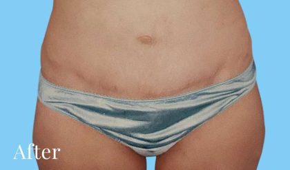 Tummy Tuck Before & After Patient #3063