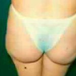 Buttock Augmentation Before & After Patient #2414