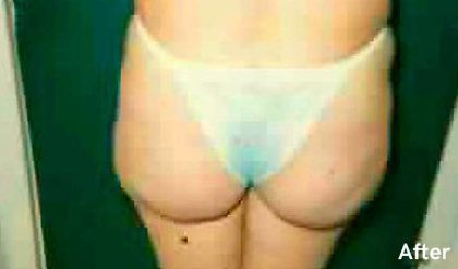 Buttock Augmentation Before & After Patient #2414
