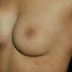 Breast Augmentation Before & After Patient #2222