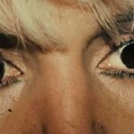Eyelid Surgery Before & After Patient #2617