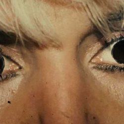 Eyelid Surgery Before & After Patient #2617