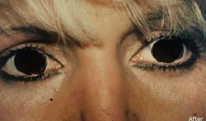 Eyelid Surgery Before & After Patient #2617