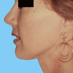 Facelift Before & After Patient #2653