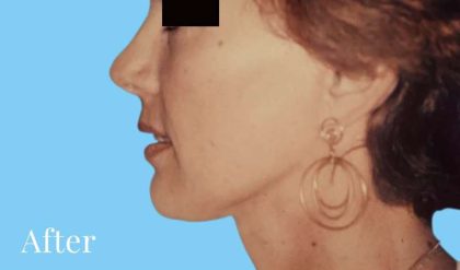 Facelift Before & After Patient #2653