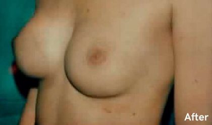 Breast Augmentation Before & After Patient #2222