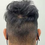 Hair Restoration Before & After Patient #2766